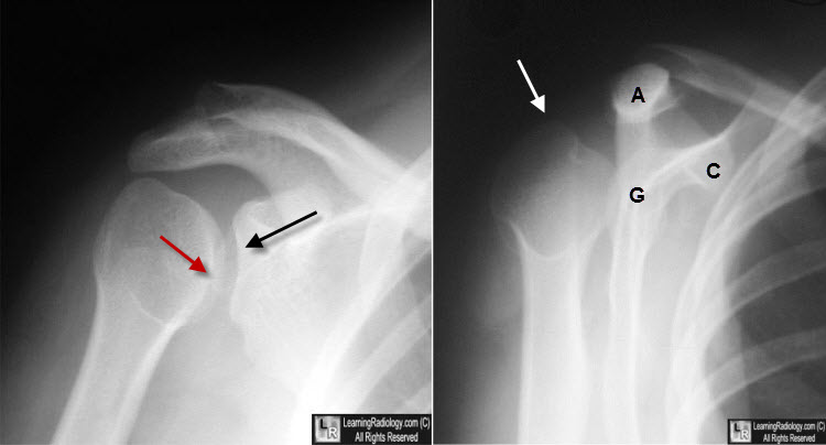 posterior shoulder dislocation